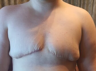 2_Months_Postop_Cropped.jpg