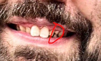 missingcaps.png