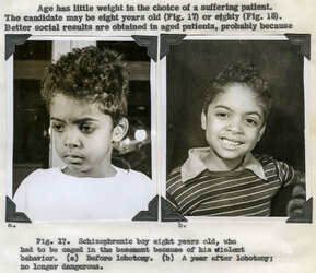 5c4829ef60cb9-before-after-lobotomy-surgery-patients-photos-4-5c459845e7549__700.jpg