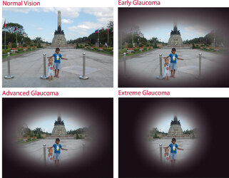 glaucoma_by_bobbylaurel_dfraouh-fullview.jpg