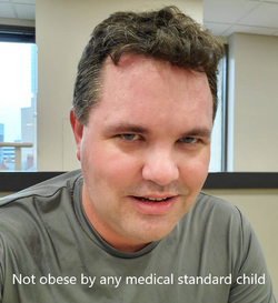 Not obese, but clinically retarded.png