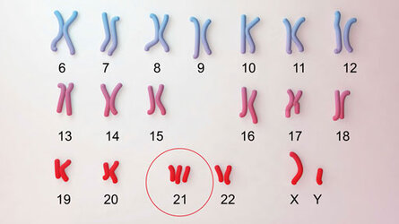 21 trisomy.jpg