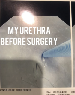 2ndsurgeryurethra-pre.PNG