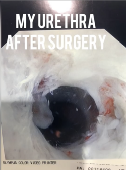 2ndsurgeryurethra.PNG