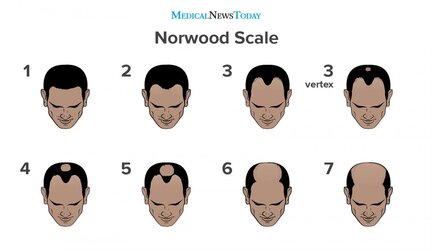 an-infographic-of-the-norwood-scale.jpg