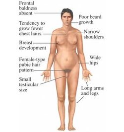 300px-Klinefelter's_syndrome_symptoms.jpg