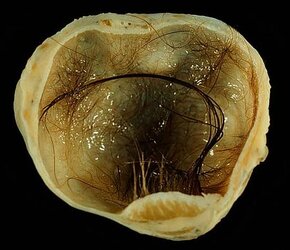 450px-Mature_cystic_teratoma_of_ovary.jpg