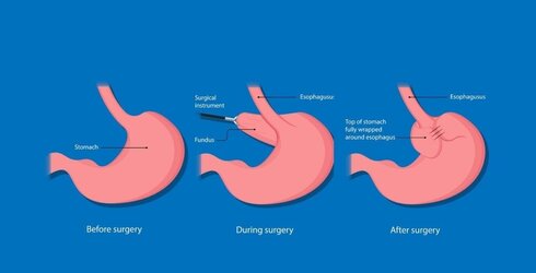 Nissen-fundoplication-Image-1024x523[1].jpg