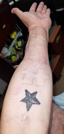 1_year_post_op_arm2.jpg.jpeg