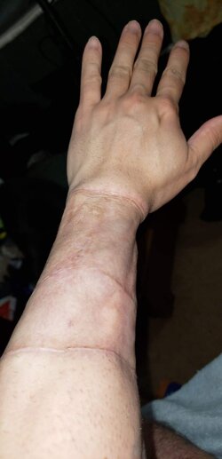 1_year_post_op_arm3.jpg.jpeg