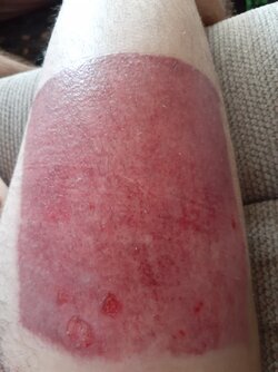 leg_graft_4_wks.jpg