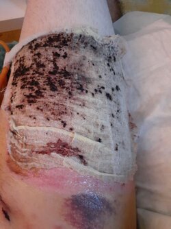 leg_graft2.jpg