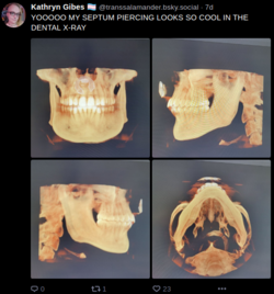 septum.png