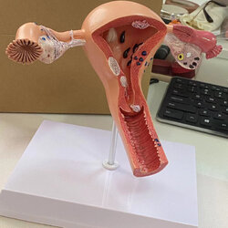 Human-Pathological-Uterus-Ovary-Model-Anatomical-Anatomy-Disease-Pathology-Medical-Lesion-for-...jpg