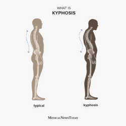 1387321-what-is-kyphosis-1080x1080-kyphosis-1024x1024_jpg.png
