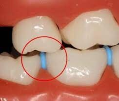 brace separator.jpg