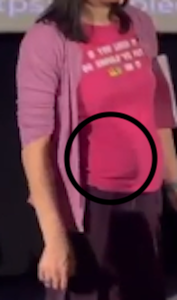 lfl colostomy.png