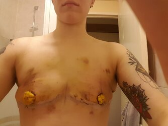 Top-Surgery-gone-wrong-1536x1152.jpg