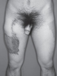 alt-phalloplasty-result-10-months-postop.jpg