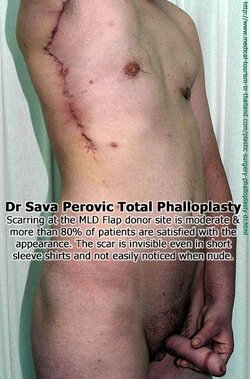 total-phalloplasty-donor-site-lg.jpg