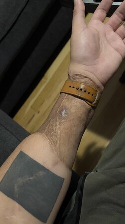 repost-about-3-years-post-op-now-donor-site-healing-v0-glud6a1na4w91.jpg
