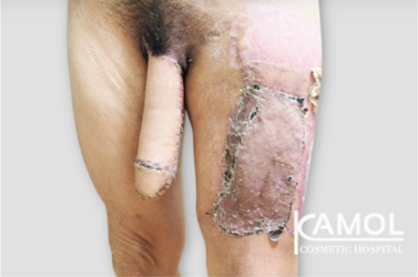 ALT-Phalloplasty-RFF-Phalloplasty-FFF-Phalloplasty-Kamol-Cosmetic-Hospital(3).png