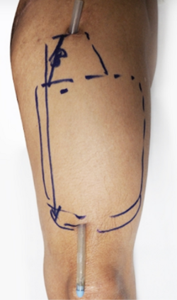 ALT-Phalloplasty-RFF-Phalloplasty-FFF-Phalloplasty-Kamol-Cosmetic-Hospital(2).png