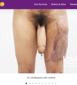ALT-Phalloplasty-RFF-Phalloplasty-FFF-Phalloplasty-Kamol-Cosmetic-Hospital(1).png