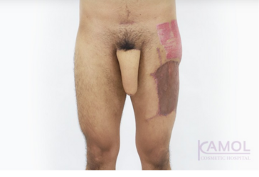 ALT-Phalloplasty-RFF-Phalloplasty-FFF-Phalloplasty-Kamol-Cosmetic-Hospital(022).png