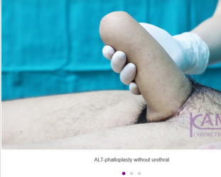 ALT-Phalloplasty-RFF-Phalloplasty-FFF-Phalloplasty-Kamol-Cosmetic-Hospital(02).png