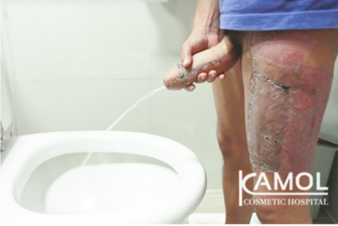 ALT-Phalloplasty-RFF-Phalloplasty-FFF-Phalloplasty-Kamol-Cosmetic-Hospital(10).png