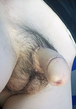 phalloplasty-f2m-lg-min.jpg