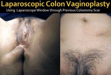 mtf-surgery-vaginoplasty_lg-min.jpg