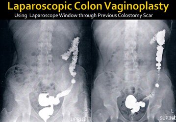 laparoscopic-colon-vaginoplasty_lg_min.jpg