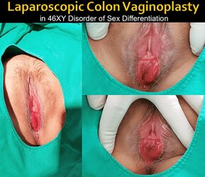 mtf-vaginoplasty_lg-min.jpg