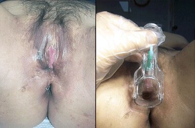 vaginoplasty_lg-min.jpg