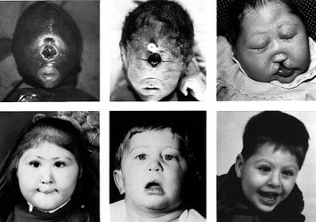 Holoprosencephaly-patients-with-deletions-or-translocations-involving-chromosomal-band.png