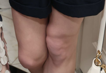 anorexia.png
