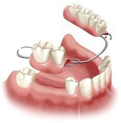 Partial-Denture.jpg Partial-Denture.jpg