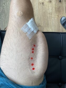 single-scar-phalloplasty-update-v0-ou1ajn96mkf91.jpg single-scar-phalloplasty-update-v0-ou1ajn96mkf91.jpg