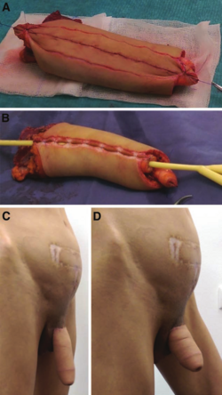 one-stage-phalloplasty-and-urethroplasty-using-only-the-lDF-resources-a-intraoperative.png