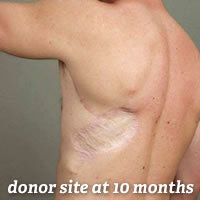 reinnervated-latissimus-dorsi-free-flap.jpg reinnervated-latissimus-dorsi-free-flap.jpg
