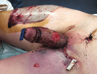 patient-WA-on-postoperative-day-10-after-phalloplasty-and-AV-fistula-showing-tissue.png