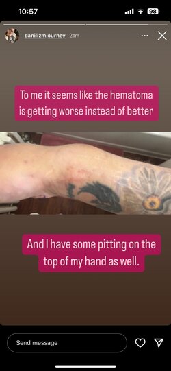 dani-thinks-her-hematoma-is-getting-worse-and-sees-pitting-v0-6a55vlml9djc1.jpeg dani-thinks-her-hematoma-is-getting-worse-and-sees-pitting-v0-6a55vlml9djc1.jpeg