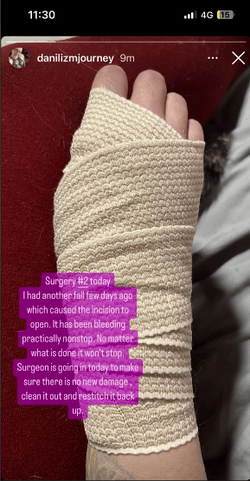 i-had-another-fall-a-few-days-ago-v0-grf5uziaz3lc1.png i-had-another-fall-a-few-days-ago-v0-grf5uziaz3lc1.png