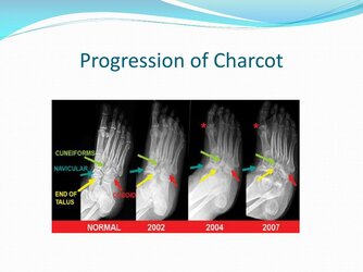 progression-of-charcot-l[1].jpg