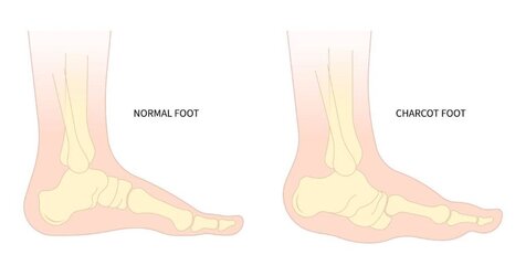 what-is-charcots-foot-1024x550[1].jpg