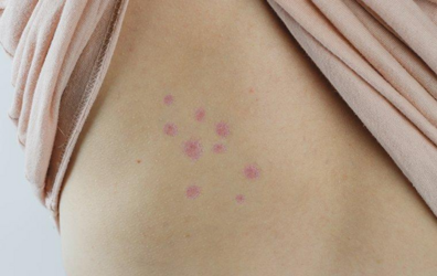 bed-bug-bites-on-skin.png