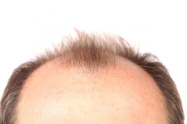 top-of-head-with-receding-hairline.jpg