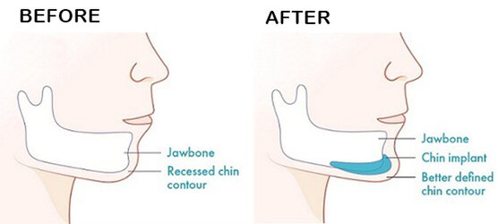 Jaw-Implant-Surgery-Cost-in-India.jpg